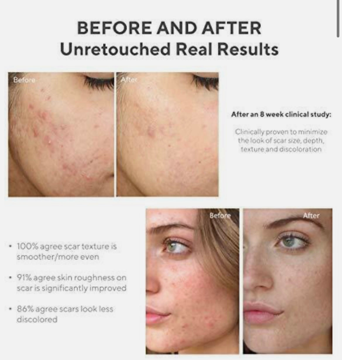 InvisiScar Resurfacing Treatment 15ml